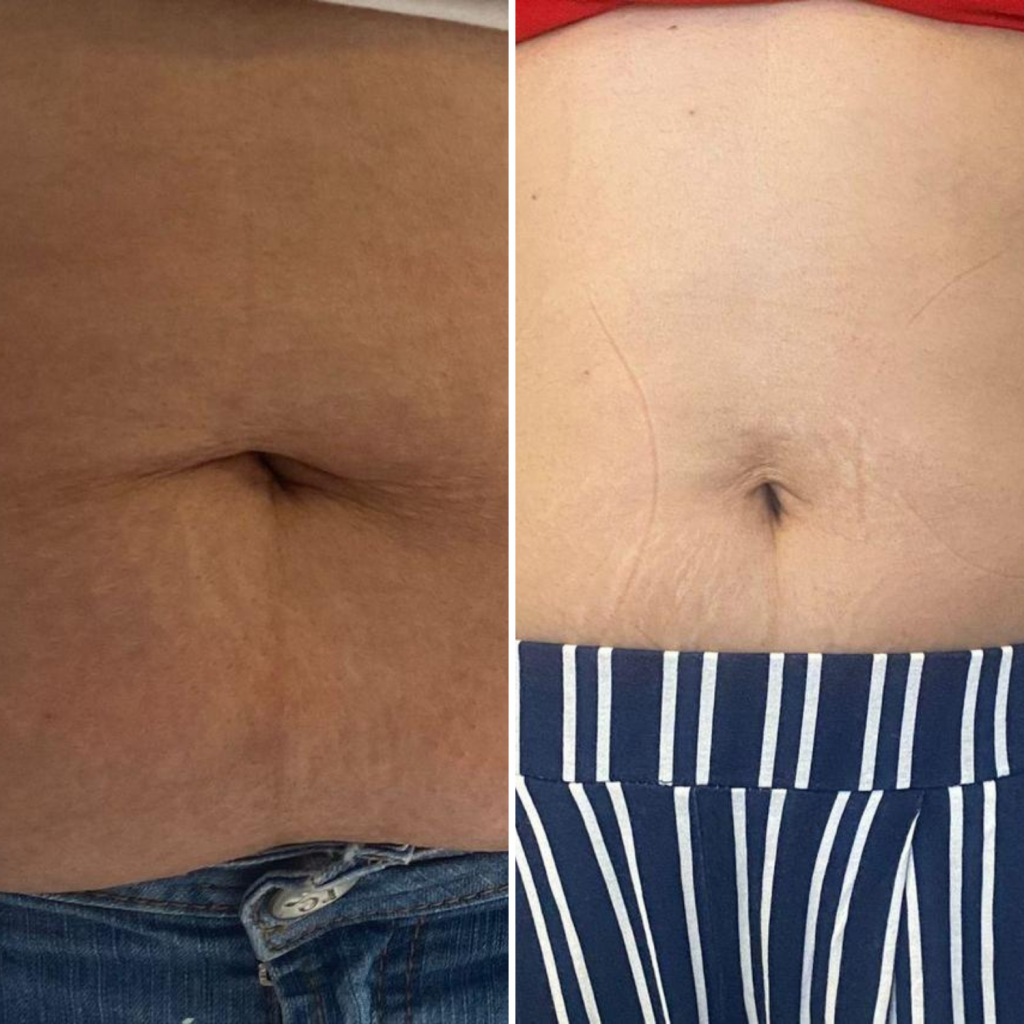Under the expert care of Faeeza, this client also underwent a focused two-month program with EMS three times per week and PPC once weekly, resulting in this impressive before-and-after transformation. Picture: Supplied